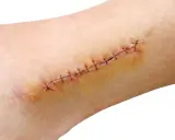 Ferita suturata con filo nero, con segni di arrossamento e possibile applicazione di amuchina disinfettante ferite per la guarigione.
