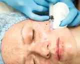 Zabieg xela rederm: igła wstrzykuje preparat w skórę twarzy, widoczne drobne zaczerwienienia i kropelki krwi.