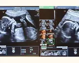 Badania prenatalne I trymestr: Co musisz wiedzieć? (do 70 znaków)