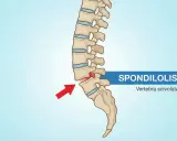 Illustrazione della spondilolistesi, con una vertebra lombare scivolata in avanti. Potrebbe causare sintomi neurologici.