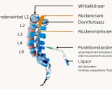 Illustration zeigt Lumbalpunktion mit Punktionskanüle im Bereich L4/L5. Mögliche Nervenreizung nach Lumbalpunktion wird durch die Nähe zum Rückenmark und den Nerven dargestellt.