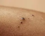 Zbliżenie na skórę nogi z kilkoma ciemnymi znamionami, w tym jedno większe, które może być czerniakiem.