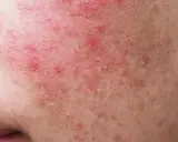 Gros plan sur une peau rougie et squameuse, signe d'une allergie cutanée au visage. Des plaques rouges et des petites pellicules sont visibles.