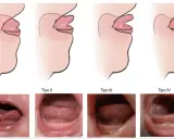 Ilustraciones y fotos muestran los tipos de anquiloglosia que es la limitación del movimiento de la lengua.