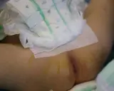 Niemowlę w pieluszce, które 3 latek sika 2 razy dziennie, leży na boku. Widoczne są ślady po wkłuciach.