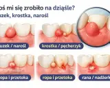 Ilustracja pokazuje różne zmiany na dziąśle: guzek, krostkę, ropę i przetokę, a także ranę. Widoczny jest ząb w dziąśle z guzem.