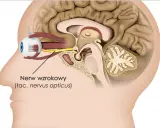 Przekrój głowy z widocznym okiem i nerwem wzrokowym. Czy zapalenie nerwu wzrokowego zawsze oznacza SM?