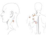 Illustration zeigt Triggerpunkte am Nacken und Rücken, die auf einen verspannten Trapezmuskel und dessen Ursache hinweisen.