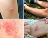 Plusieurs réactions cutanées, dont une piqure de moustique infectée, montrent une inflammation et des rougeurs sur la peau.
