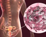 Anatomía femenina con detalle ampliado de vaginosis bacteriana.