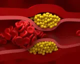 Zator w naczyniu krwionośnym: czerwone krwinki i żółte złogi cholesterolu nie-hdl blokują przepływ.