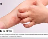 Braccio con arrossamento e sfogo cutaneo, un dito che si gratta. Potrebbe essere dermatite da stress senza prurito.