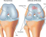 Vergleich eines gesunden Knies mit Arthrose. Arthrose zeigt Knorpelschäden, Knochenexposition und Osteophyten, was zu steifen Gelenken führt.