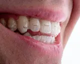 Uśmiech z niewidocznymi nakładkami Invisalign Comprehensive, które delikatnie korygują zgryz.