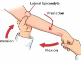 Illustration zeigt einen Tennisarm Test. Der Arzt drückt auf den lateralen Epikondylus, während er Extension und Pronation des Arms ausführt.