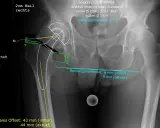 Röntgenbild des rechten Hüftgelenks mit Markierungen zur Beurteilung der coxarthrose stadien und der Beinlänge.