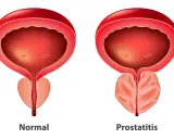 Porównanie: prawidłowa prostata i przerost gruczołu krokowego. Widoczny powiększony gruczoł krokowy uciska cewkę moczową.