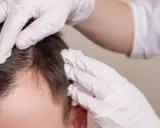 Hände in weißen Handschuhen untersuchen die Kopfhaut eines Mannes, um Haarausfall zu verhindern.