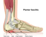 Anatomische Darstellung des Fußes, die zeigt, wie die Plantarfasziitis immer schlimmer wird, mit Entzündung an der Ferse.