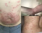 Punture di acaro su addome, braccio e schiena. Lesioni cutanee rosse e pruriginose diffuse.