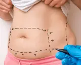 Liposukcja: Odkryj prawdę o odsysaniu tłuszczu. Co musisz wiedzieć?