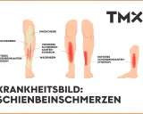 Illustrationen zeigen verschiedene Ursachen für starke Schmerzen im Schienbein im Ruhezustand, wie das vordere und hintere Schienbeinkantensyndrom.