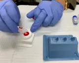 Manos enguantadas realizan prueba rápida para diagnóstico y tratamiento de gonorrea.