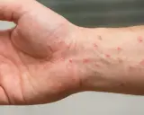 Pelle arrossata e irritata sul polso, con piccole pustole e graffi, sintomi di dermatiti da acaro.