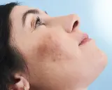Primo piano del viso di una donna con macchie cutanee visibili, che mostra come coprire le macchie sul viso per un incarnato uniforme.