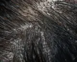 Gros plan sur un cuir chevelu présentant des pellicules grasses, avec des cheveux noirs fins qui poussent à travers.
