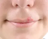 Bouton de fièvre sur la lèvre, un signe qu'il faut trouver un remède rapidement.