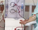 Pacjent podłączony do aparatu do dializy. Czerwone przewody doprowadzają krew do maszyny, która oczyszcza ją. To właśnie dializa co to jest w praktyce.