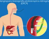 ERCP: endoscopio inserito per rimuovere calcoli che causano ostruzione coledoco.
