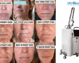 Progressione del viso prima e dopo il trattamento laser CO2 frazionato, mostrando il recupero in 7 giorni. Le recensioni confermano l'efficacia.