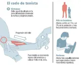 Codo de tenista: Síntomas clave, causas y alivio efectivo ¿Lo sufres?