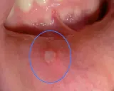 Una piccola bolla in bocca a un bambino, evidenziata da un cerchio blu. Potrebbe essere un afta o una piccola lesione.