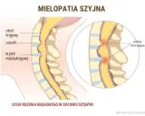 Objawy neurologiczne kręgosłupa szyjnego: kiedy to poważne?
