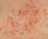 Wybroczyny na skórze, jeden z niepokojących objawów meningokoków. Czerwone plamki i wybroczyny mogą świadczyć o groźnej infekcji.