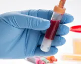 Ręka w niebieskiej rękawiczce trzyma probówkę z krwią. W tle pojemnik z żółtym płynem, sugerującym badanie moczu, gdzie może być obecne białko i krew.