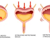 Ilustracja pokazuje różne rodzaje nietrzymania moczu: przepełnienie, wysiłkowe i z nagłymi parciami.