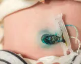 Piccolo granuloma ombelicale con clip e cordone residuo su pelle neonatale.