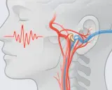 Pulssynchroner Tinnitus durch Nackenverspannung: Rote Wellen zeigen den Puls nahe dem Ohr, wo Blutgefäße und ein Gelenk dargestellt sind.