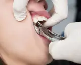 Chirurgiczne usuwanie zęba w trakcie zabiegu. Dentysta w białej rękawiczce używa kleszczy stomatologicznych.