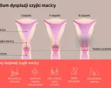 Grafika przedstawia stadia dysplazji szyjki macicy: I, II i III stopień, z zaznaczoną tkanką uszkodzoną w III stadium. Poniżej objawy: ból podczas stosunku, plamienia, ból brzucha, obfite miesiączki, podrażnienie pochwy.