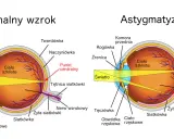 Porównanie budowy oka z normalnym wzrokiem i astygmatyzmem. Brak domowy sposób na astygmatyzm.
