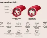 Porównanie poziomu żelaza: prawidłowy vs. niedobór. Niedobór żelaza objawia się m.in. bladością skóry, zmęczeniem, bólami głowy.