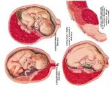 Illustrazioni mediche mostrano complicazioni della gravidanza: sanguinamento interno/esterno, ostruzione cervicale e distacco prematuro della placenta, evidenziando la placenta bassa.
