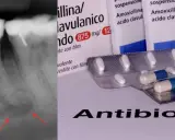 Radiografia dentale con segni di infezione e confezioni di amoxicillina/acido clavulanico, un antibiotico e antinfiammatorio.