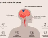 Ilustracja pokazuje mózg z zaznaczonym obszarem bez dopływu krwi, co może powodować dziwne uczucie w głowie. Wymieniono też inne przyczyny zawrotów głowy.