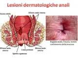 Illustrazione anatomica dell'ano e immagine ravvicinata di una ragade anale con freccia che indica lo scollamento della mucosa. Si notano puntini bianchi nell'area anale.